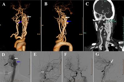 Endovascular Treatment of Congenital Internal Carotid-Jugular Fistula